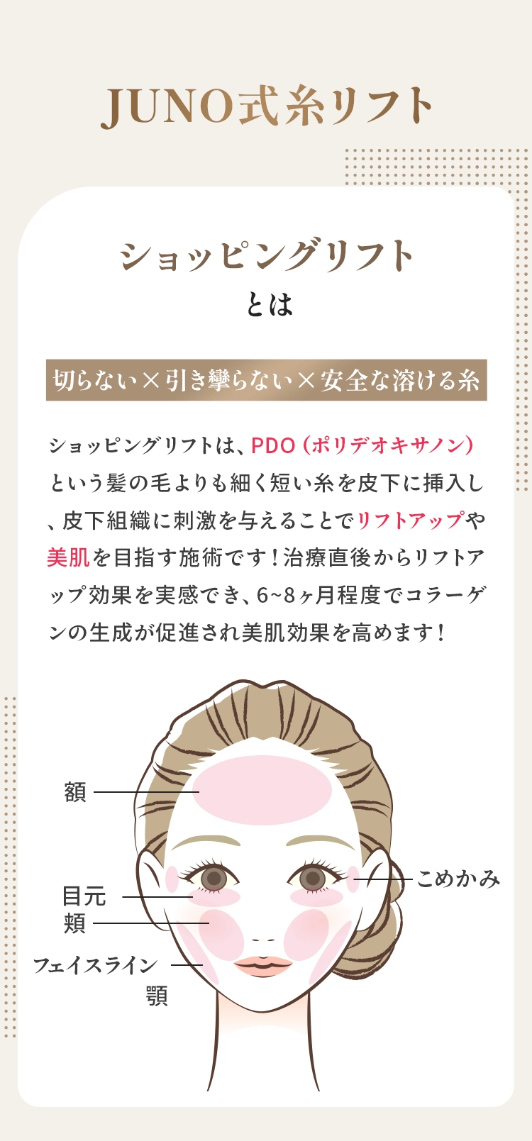 JUNO式糸リフトショッピングリフトとは