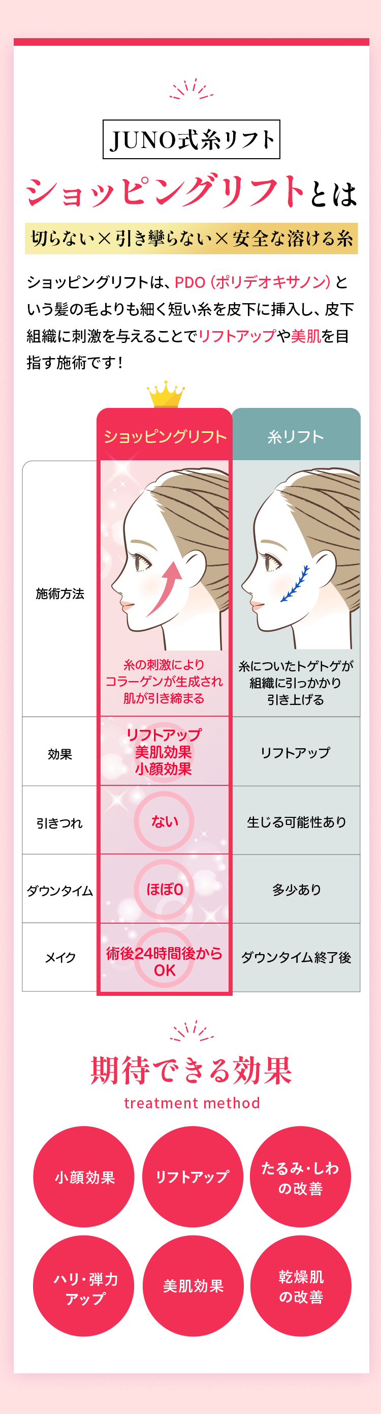 JUNO式糸リフト ショッピングリフトとは